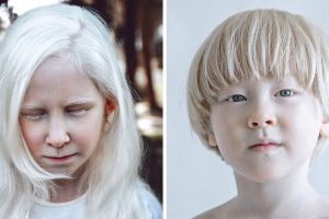 Egy fotós albinizmussal élő emberekről készít képeket, hogy bemutassa lenyűgöző és egyedi szépségüket