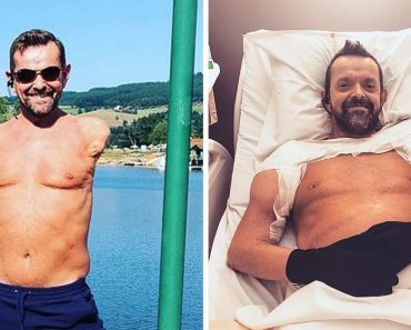 Egy férfi, akinek amputálták a karját és a vállát, újra tud integetni