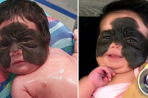 Így néz ki most az a kislány, akinek egy úttörő műtéttel végre eltávolították a „Batman” anyajegyét