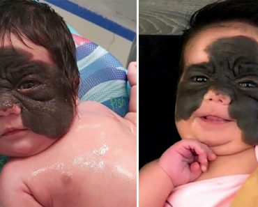 Így néz ki most az a kislány, akinek egy úttörő műtéttel végre eltávolították a „Batman” anyajegyét