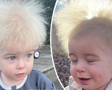 A rendkívül ritka, fésülhetetlen hajszindrómás kisgyermek összezavarja az anyukát: orvosa 19 éve nem látott ilyet