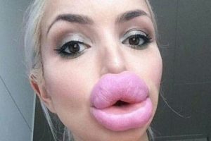 13 ember, aki valószínűleg megbánta, hogy megcsináltatta az ajkait.
