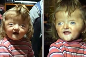 A 2 éves kislányt kitiltottak az óvodából, mert deformált koponyája „megijesztené a többi gyermeket”