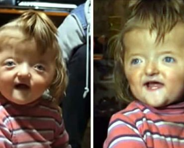 A 2 éves kislányt kitiltottak az óvodából, mert deformált koponyája “megijesztené a többi gyermeket”