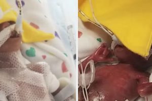 Egy évvel ezelőtt születtek meg a világ legkoraszülöttebb ikrei – itt vannak ma