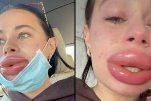 A nő figyelmeztetést ad ki az „ingyenes kozmetikai munkák” elvégzéséről, miután az ajkai fájdalmasan nagyra nőttek