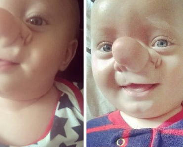 A „Pinokkió” gyermeket furcsa orra miatt cukkolták – sosem fogod kitalálni, hogy néz ki ma, 9 évvel később