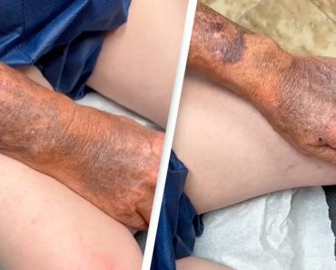 A férfi megmutatja a naptejhasználat fontosságát, mivel sokkoló különbséget mutat a karja és a lába között
