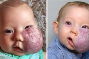 Sloan McGillis hihetetlen története: Óriási arcdaganattal született – de legyőzött minden akadályt