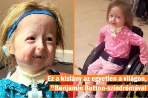 A 6 éves lány óriási sebességgel öregszik a szindróma miatt, amelyet a világon senki sem tapasztalt még, és az orvosok nem tudják meghatározni a betegséget