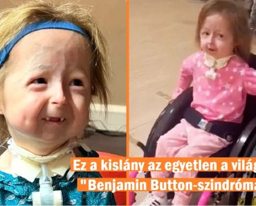 A 6 éves lány óriási sebességgel öregszik a szindróma miatt, amelyet a világon senki sem tapasztalt még, és az orvosok nem tudják meghatározni a betegséget