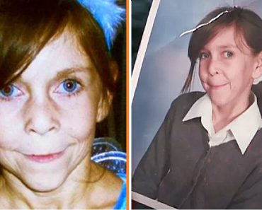 A 12 éves lányt a ráncos arca miatt kegyetlenül „nagyinak” csúfolták — Évekkel később „gyönyörűen” néz ki az arcműtét után