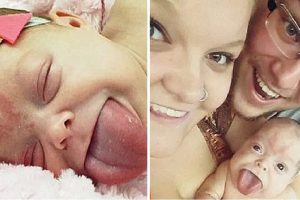 Az anyuka hatalmas, életveszélyes nyelvvel hozta világra a babát — egy év múlva végre mosolyog a kisfiú
