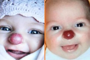 A piros orral született lányt kegyetlenül „Rudolfnak” csúfolták – most 14 évesen „gyönyörű” tini lett belőle