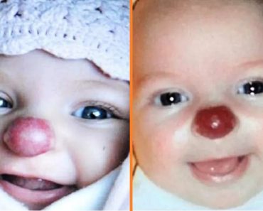 A piros orral született lányt kegyetlenül „Rudolfnak” csúfolták – most 14 évesen „gyönyörű” tini lett belőle