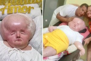 A lány „óriási fejjel” születik, amely folyamatosan nő – 30 évvel később az orvosok csodálkozva látják