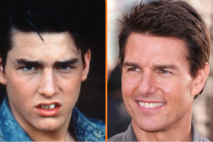Tom Cruise „görbe” fog átalakulása vitát vált ki, egy másik ikon „új” fogai lenyűgözték a rajongókat